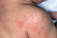 baby dry skin rash